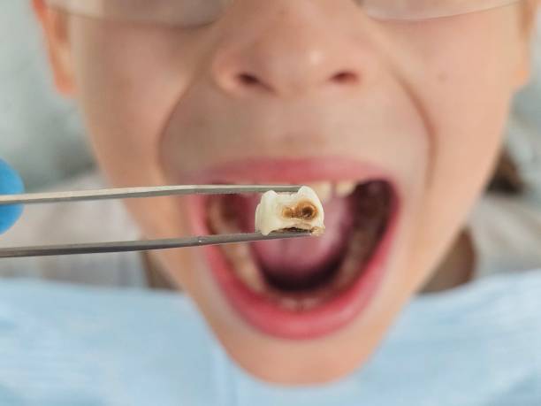 Best Emergency Wisdom Teeth Removal in Christmas, FL